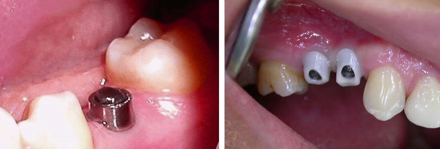 s_implant.jpg s_implant.jpg